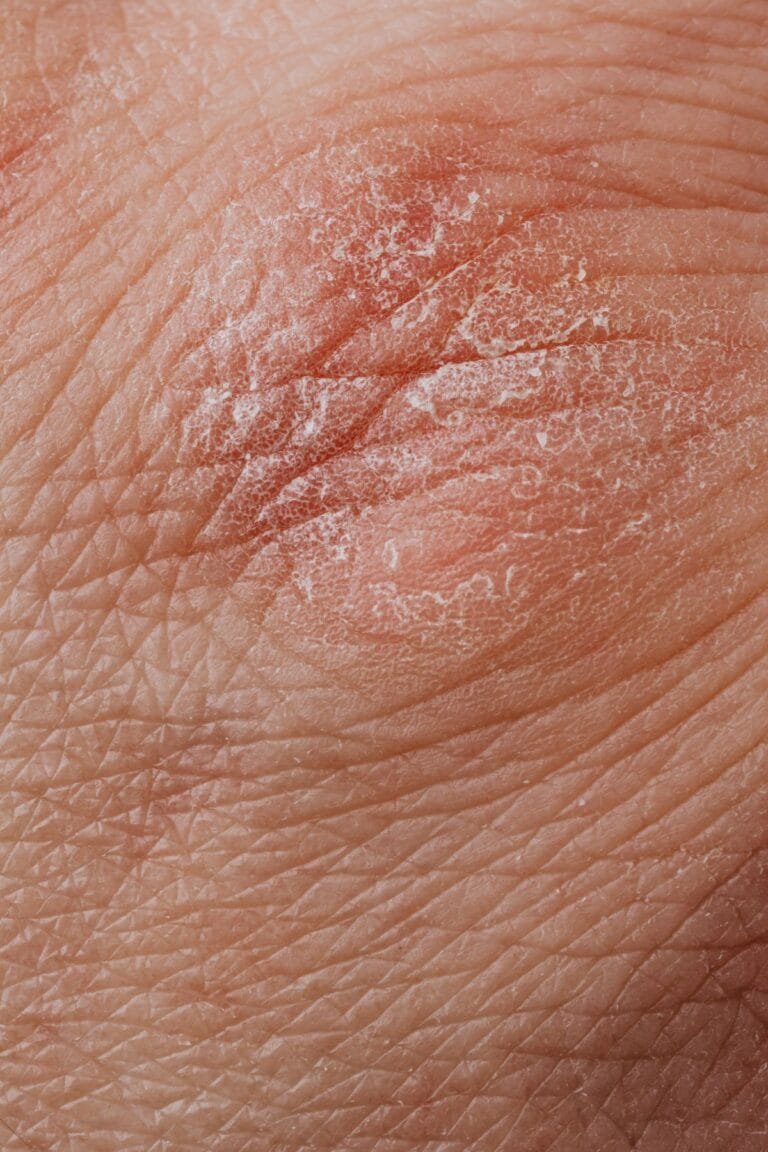 Close-up of psoriasis skin plaque