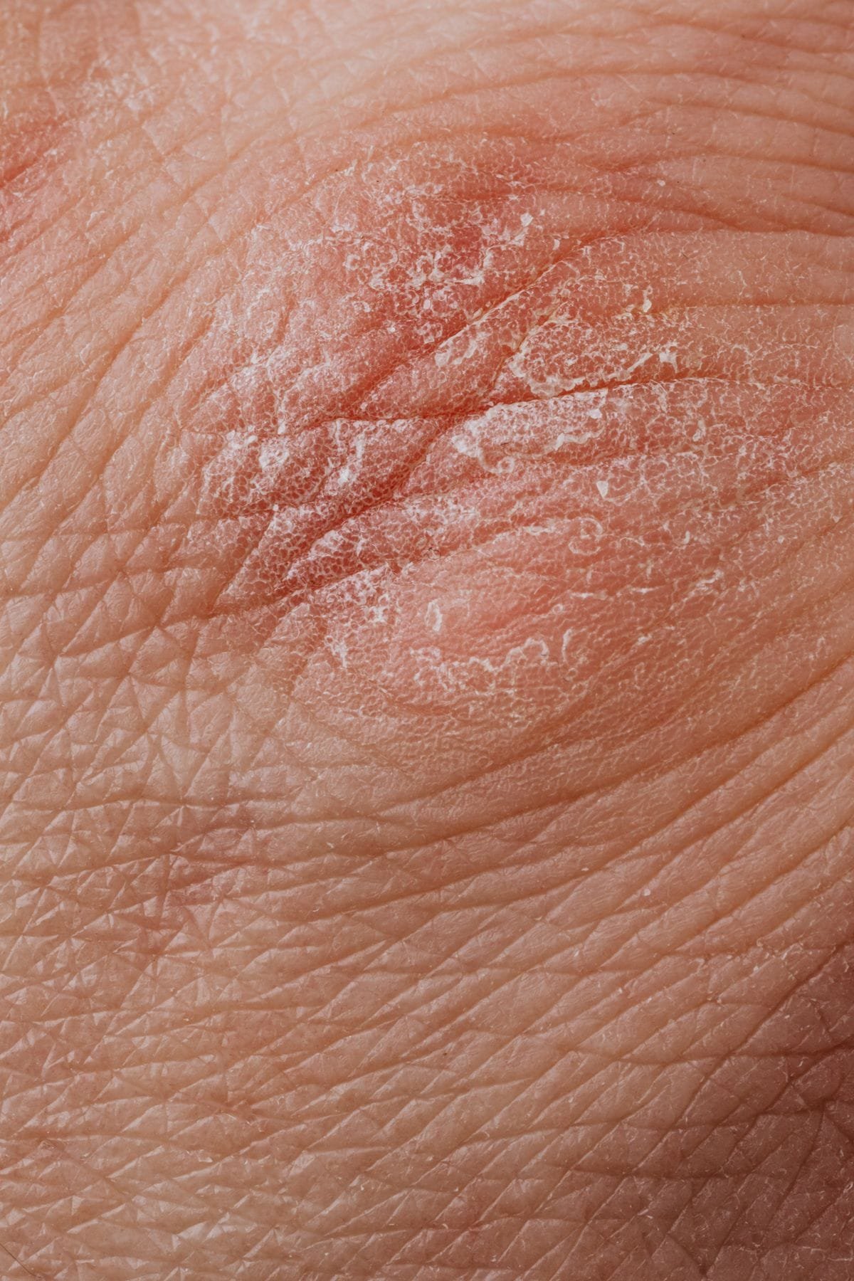 Close-up of psoriasis skin plaque
