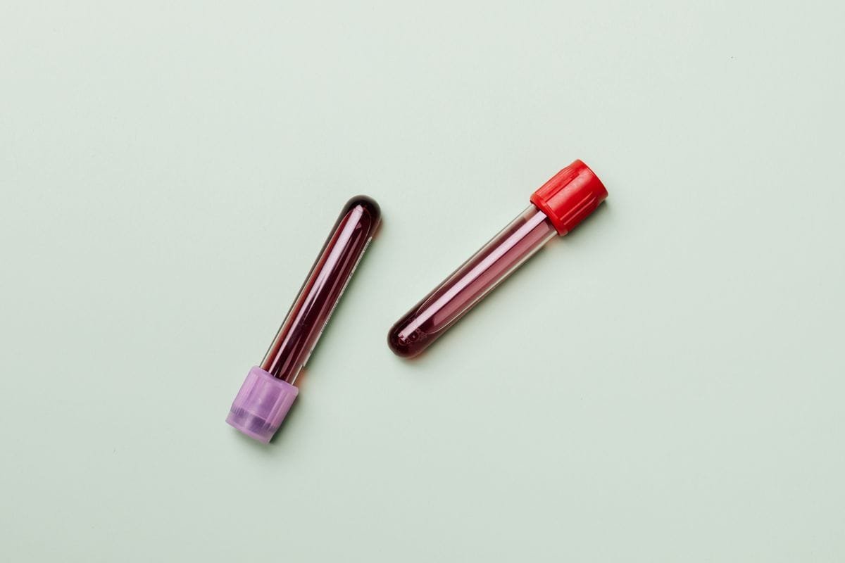 Blood test tubes for uric acid level testing
